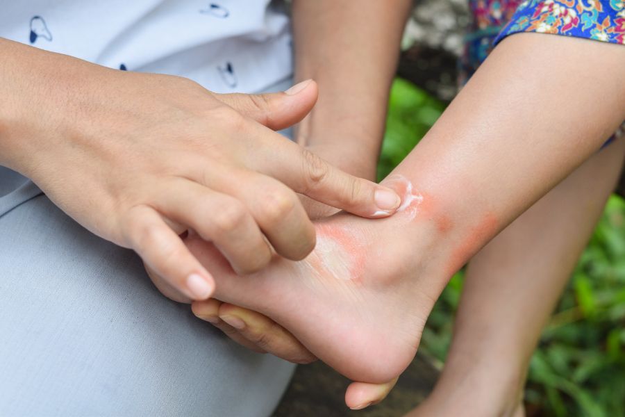Treating mosquito bites in Cordova, TN |  Allied Termite & Pest Control